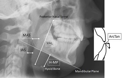 Elevated Hyoid Bone Position in Response to Mandibular Advancing Appliance Predicts Effectiveness of the Appliance for Obstructive Sleep Apnea